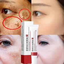 Whitening Freckle Cream Remove Melasma Melanin Dark Spots Lightening Cream